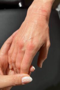 Hand Nach Frax Laserbehandlung Hautstraffung Hand Nach Frax Laserbehandlung Hautstraffung