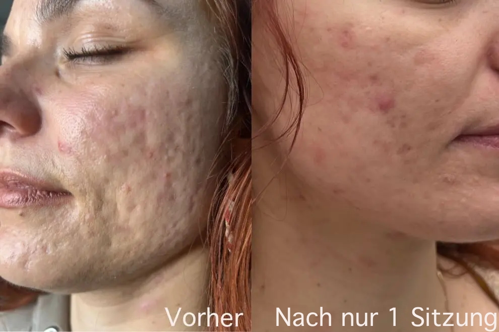 Kunde Erfahrungsbericht Dauerhafte Haarentfernung Aknenarben Entfernen Laser Vorher Nachher2