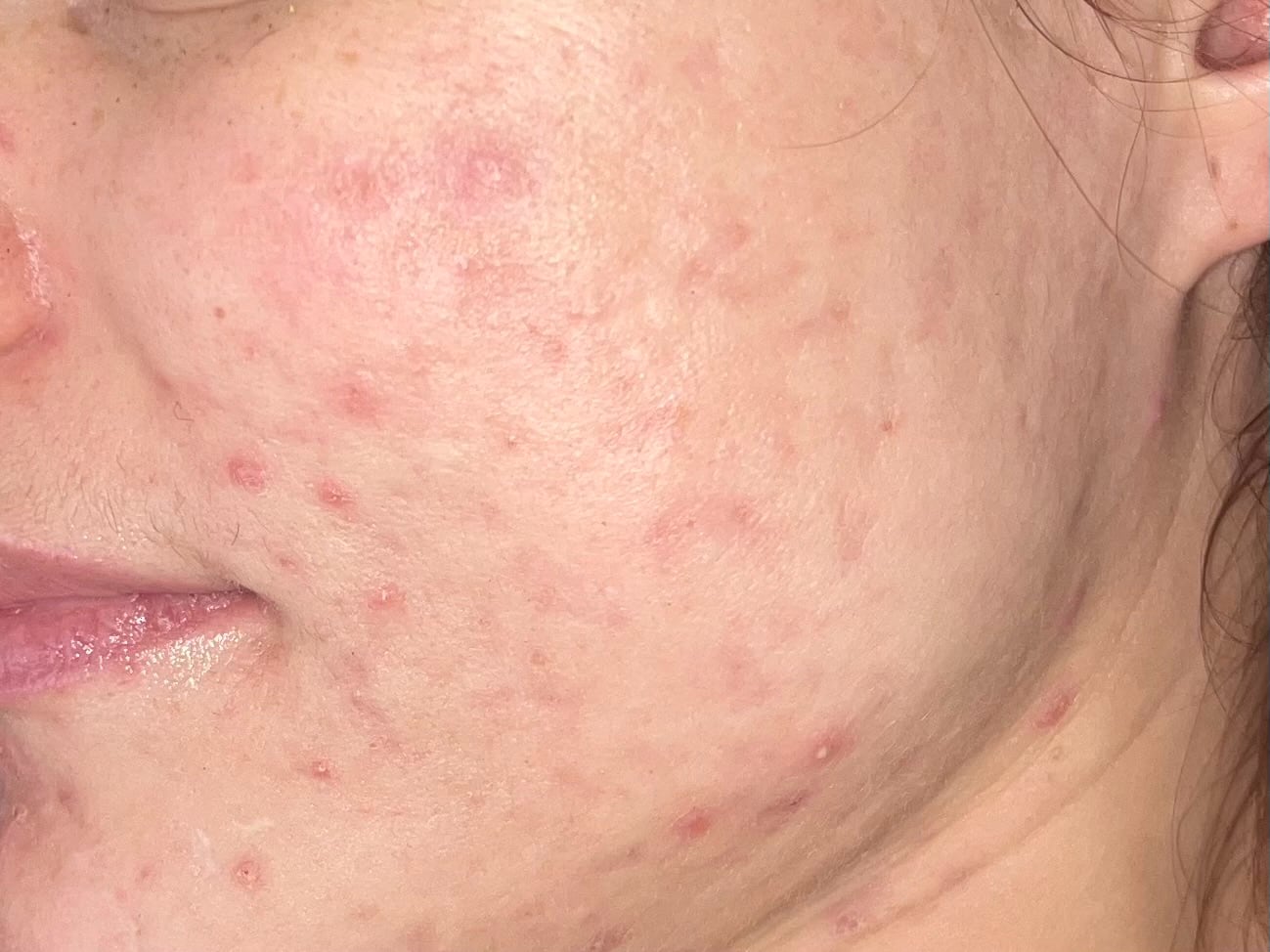 Hand Nach Frax Laserbehandlung Hautstraffung Aknenarben Entfernen Laser