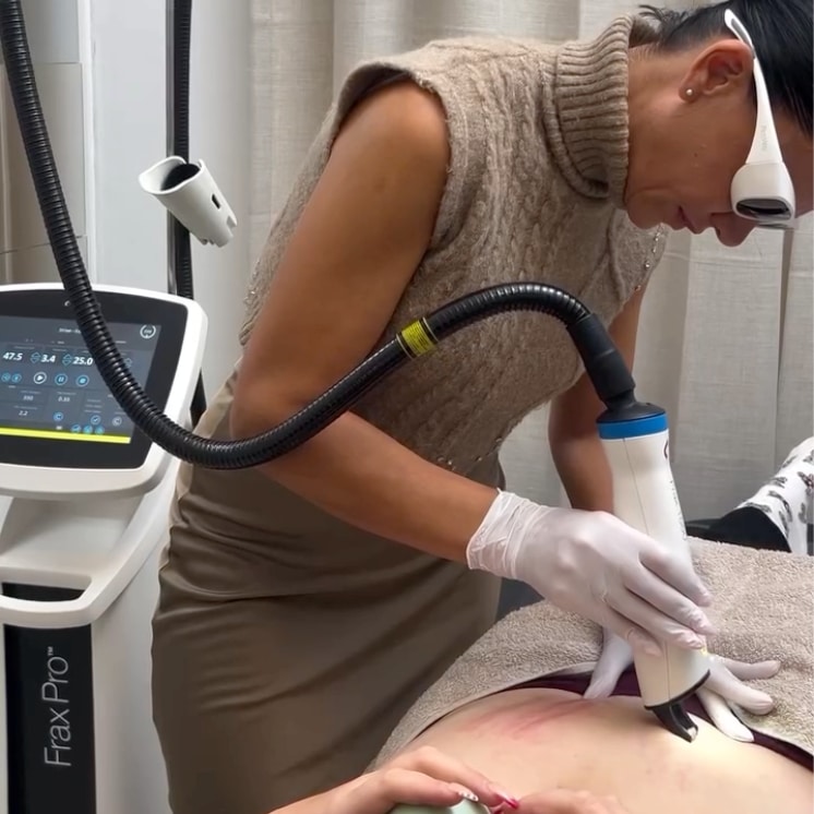 Dekolettee Hals Hautverjuengung Dehnungsstreifen Entfernen mit Lasertherapie