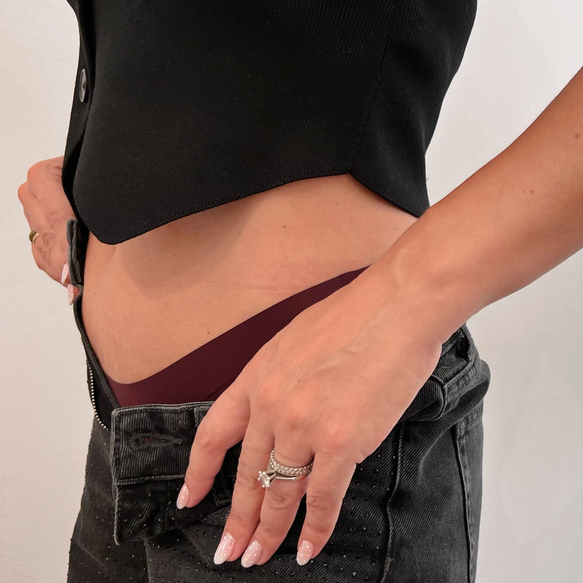 Hautverbesserung Faltenbehandlung Mit Fraxlaser Frax Behandlung Dehnungsstreifen Schwangerschaftsstreifen